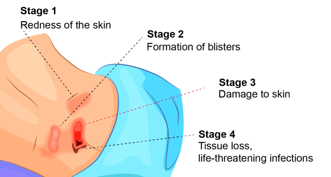 How to Determine if a Resident is at a High Risk of Pressure Ulcers